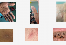 La OMS declara emergencia sanitaria global por el brote de Mpox en África